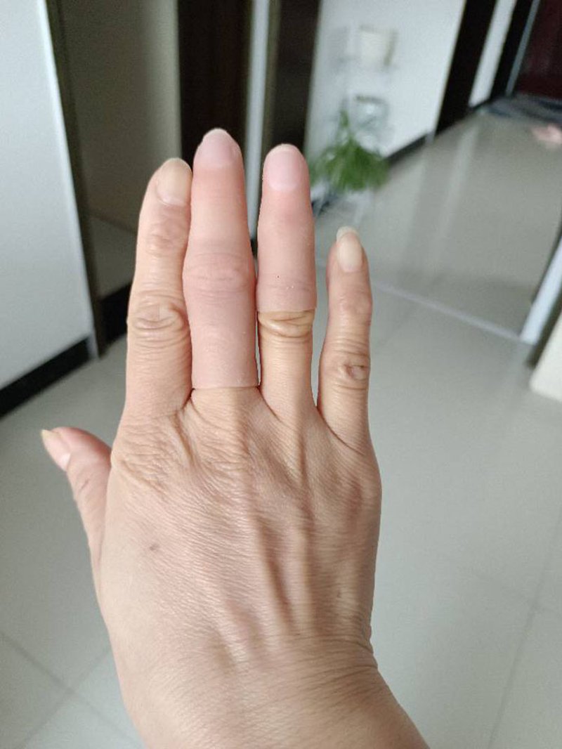 假手指:个性化定制与材料革新